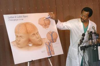 Dr.Carson talking about the conjoined twins (vibesngists.blogspot.com ())